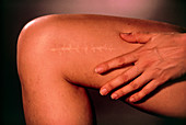 Operation scar on woman's leg