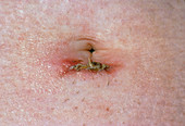 Close up of infected laparoscopy scar