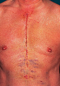 Coronary bypass scar on chest of male patient