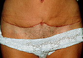 Abdominal scar on woman after lipectomy surgery