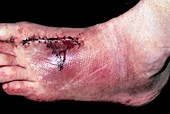 Suture scar on crushed foot after road accident