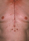 Heart surgery chest scar
