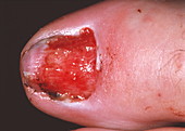 Wound after toenail removal