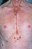 Coronary bypass chest scar