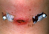 Infected scar after birthmark removal