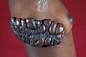 Keloid scar