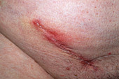 Hernia scar