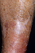 Scar on a woman's leg