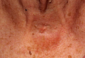 Tracheostomy scar