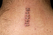 Spinal surgery scar