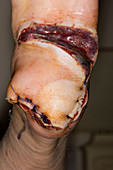 Melanoma excision scar