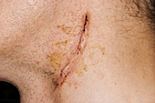 Lymph node biopsy scar