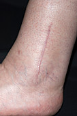 Scar on a fractured ankle
