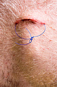 Sutured surgical incision