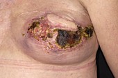 Infected wound after breast surgery