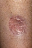 Melanoma excision wound