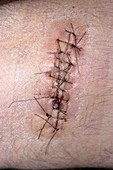 Stitched scar following surgery
