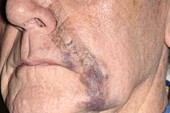 Bruising following skin cancer surgery