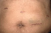 Abdominal scars after stomach surgery
