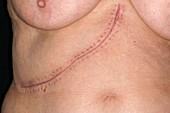 Surgical scar