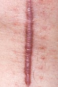 Keloid scar