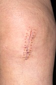 Knee surgery scar
