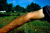 Effects of sunburn on a man's arm