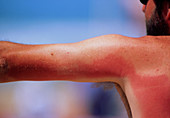 Sunburn on man's back and arm