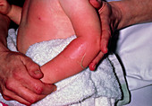 Hot water burns on an infant's arm and chest