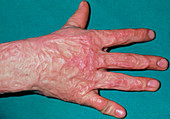 Burns: severe scarring on hand of boy aged 9
