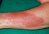 Close up: second degree burn to male left forearm