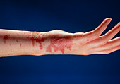 Burn on lower arm and hand caused by boiling fat