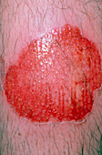Close-up of infected leg burn from steam cleaner