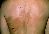 Darkened skin on back after childhood sunburn