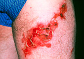Boiling water burn on a 58 year old man's leg