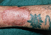 Skin graft on arm to remove tattoo