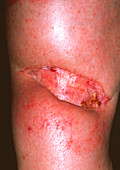 Skin graft on leg