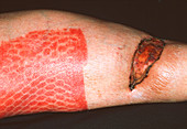 Skin graft on leg