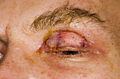 Eyelid skin graft