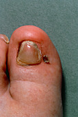 Ingrowing big toenail