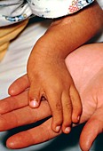 Deformed hand & forearm of thalidomide baby