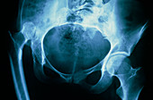 Tinted x-ray of dislocated hip