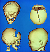 3-D CT scans of infant skull post-op for deformity