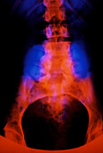 False-colour X-ray of meningomyelocele