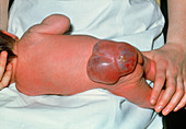 Newborn child with spina bifida