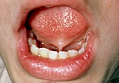 Example of tongue-tie,a congenital deformity