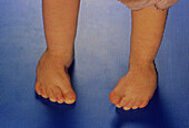 Infant with club feet (Talipes equinovarus)