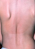 Scoliosis (sideways curvature of the spine)