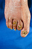 Top view of foot showing severe hammer toes