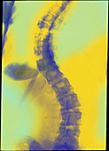 Coloured X-ray of scoliosis (curvature) of spine